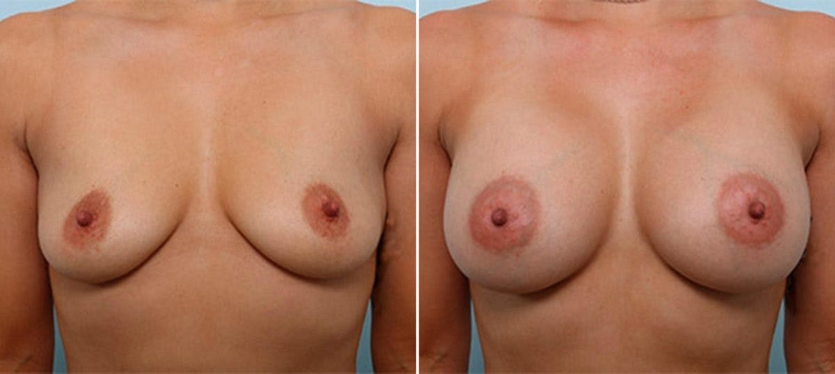 Breast Augmentation Before & After Gallery - Patient 54886992 - Image 1