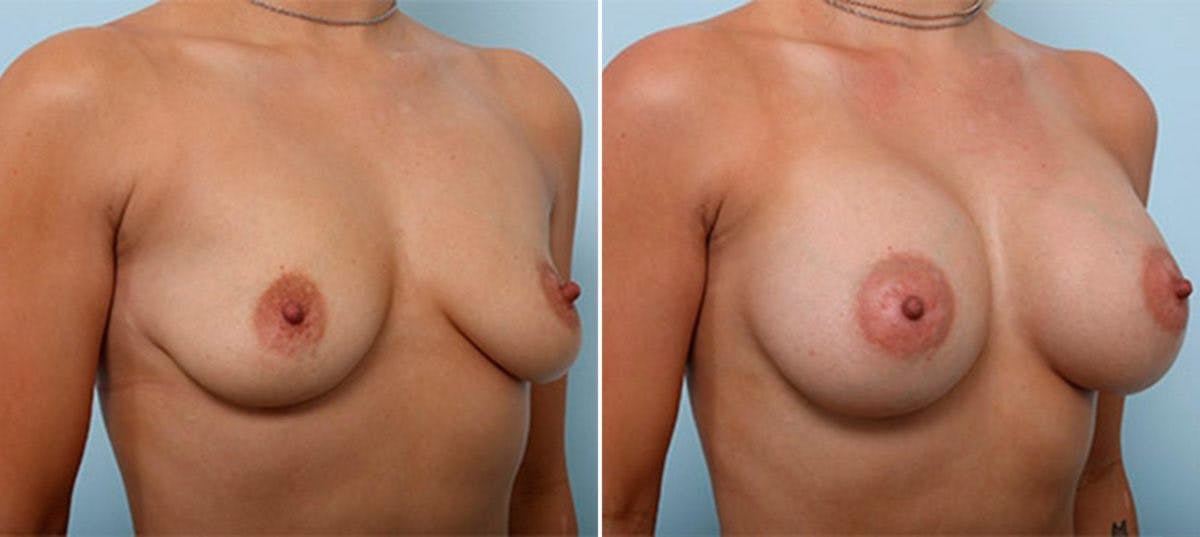Breast Augmentation Before & After Gallery - Patient 54886992 - Image 2