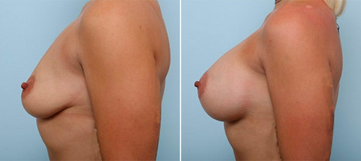 Breast Augmentation Before & After Gallery - Patient 54886992 - Image 5
