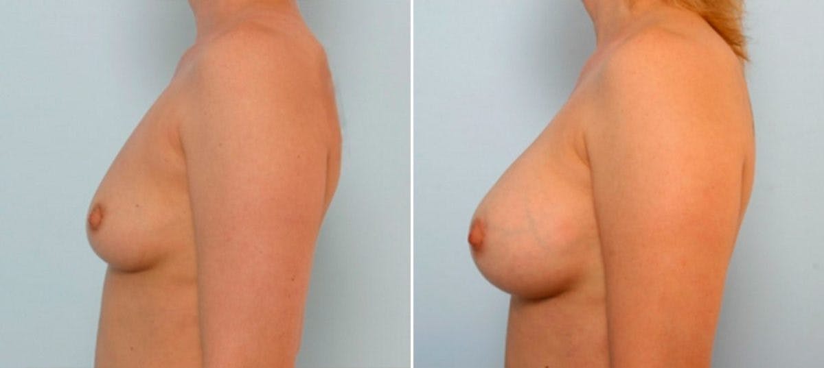 Breast Augmentation Before & After Gallery - Patient 54886995 - Image 5