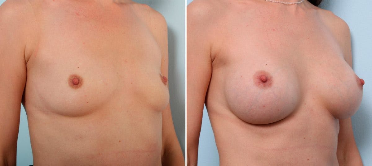 Breast Augmentation Before & After Gallery - Patient 54886998 - Image 2