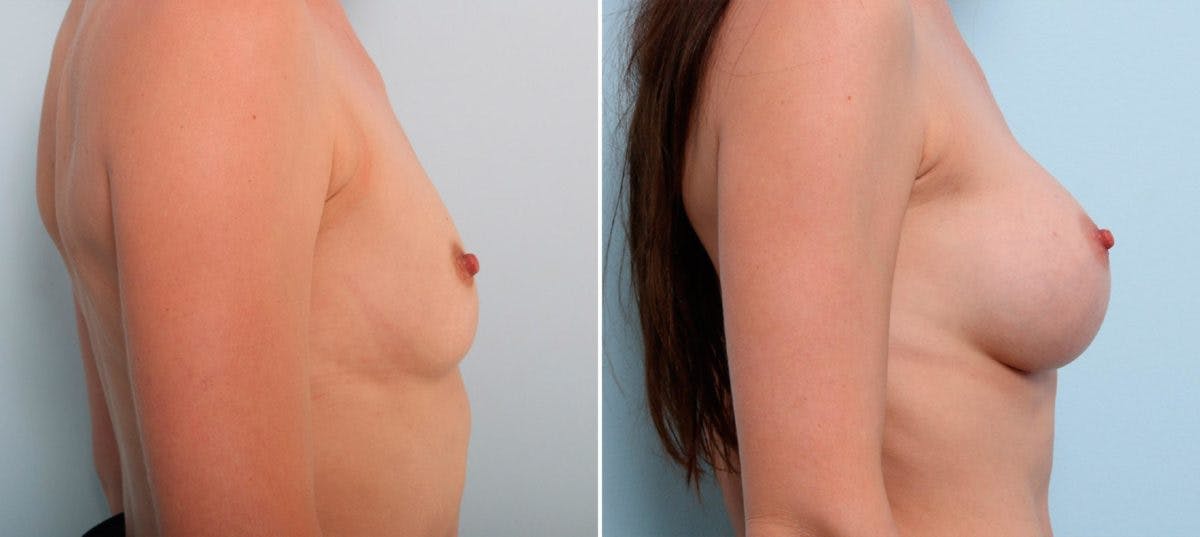 Breast Augmentation Before & After Gallery - Patient 54886998 - Image 3