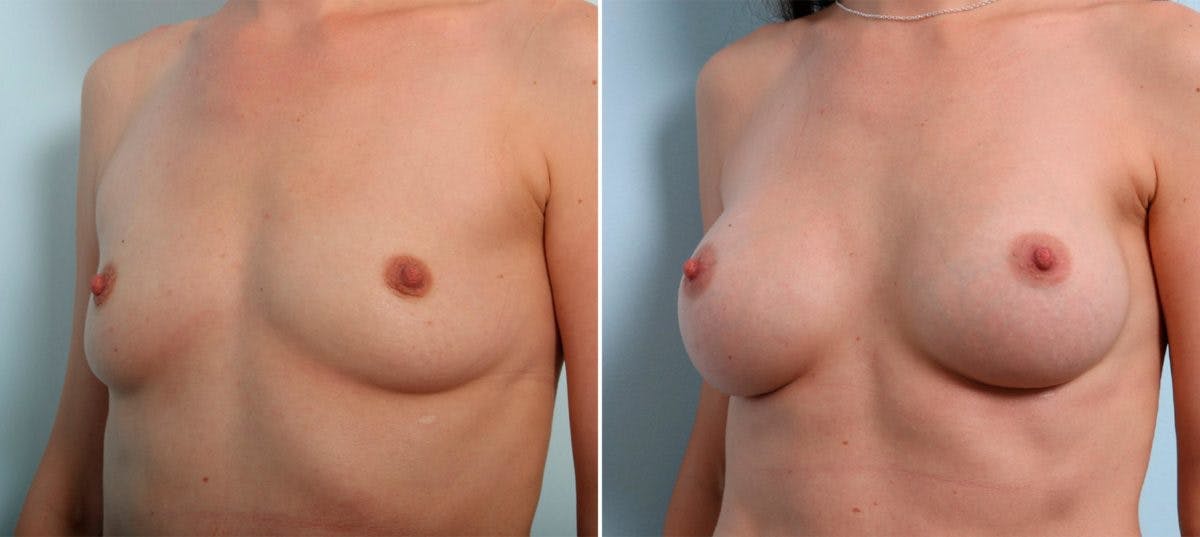 Breast Augmentation Before & After Gallery - Patient 54886998 - Image 4