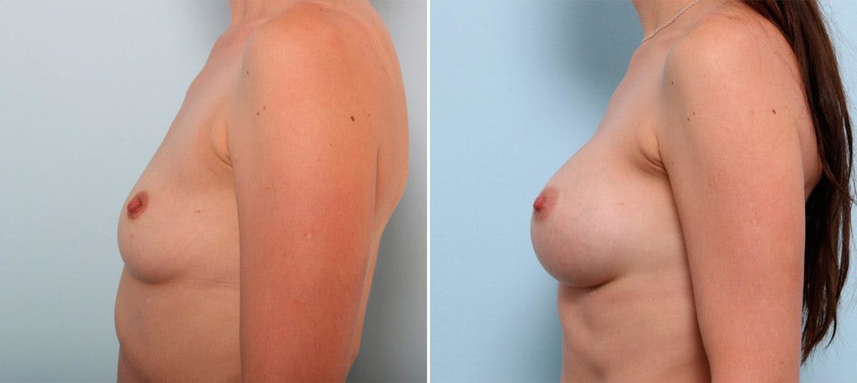 Breast Augmentation Before & After Gallery - Patient 54886998 - Image 5