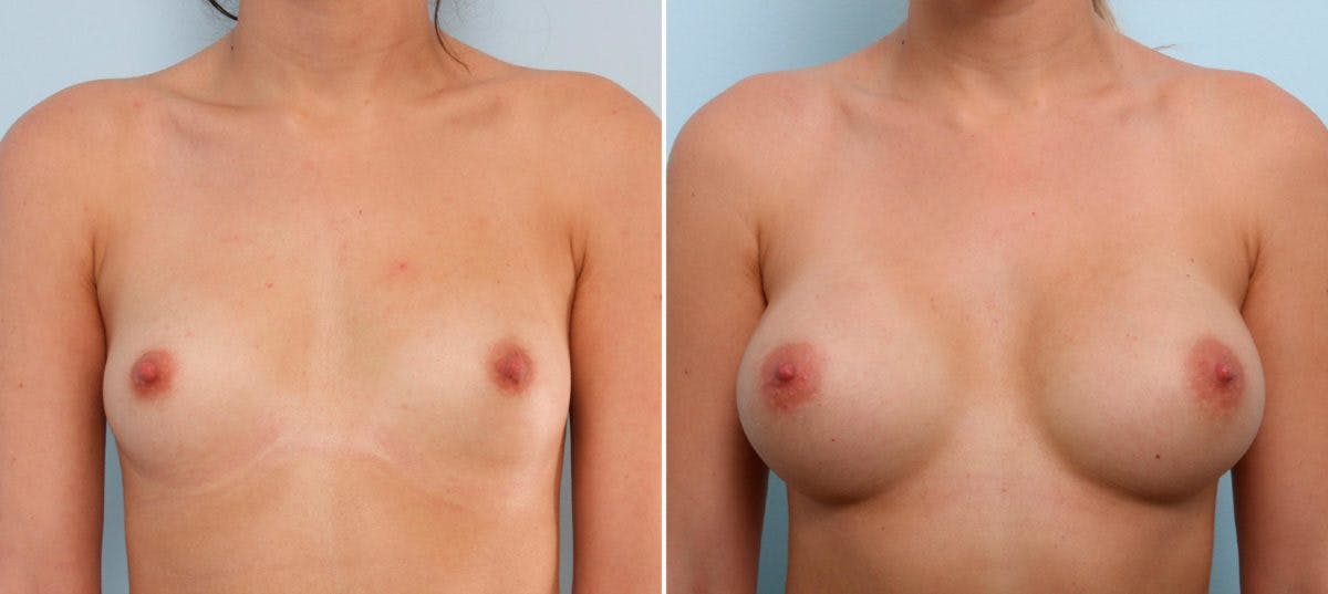 Breast Augmentation Before & After Gallery - Patient 54887000 - Image 1