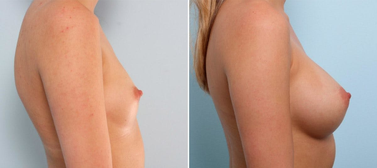 Breast Augmentation Before & After Gallery - Patient 54887000 - Image 3