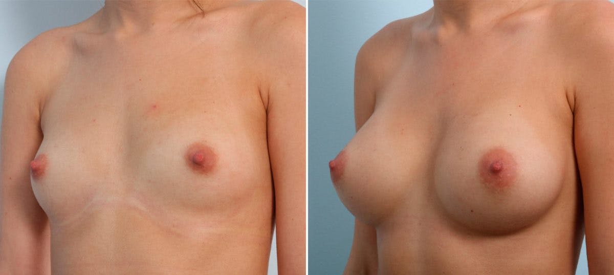 Breast Augmentation Before & After Gallery - Patient 54887000 - Image 4