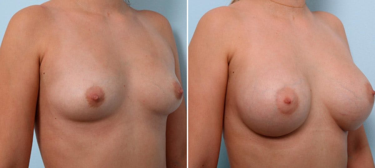 Breast Augmentation Before & After Gallery - Patient 54887004 - Image 2