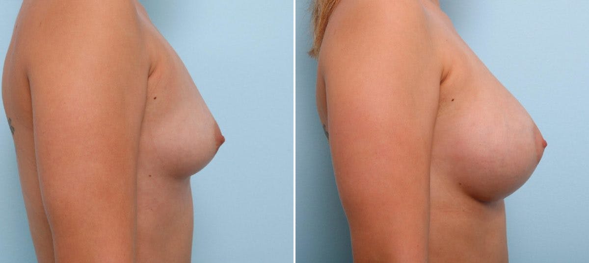 Breast Augmentation Before & After Gallery - Patient 54887004 - Image 3