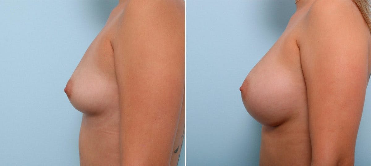 Breast Augmentation Before & After Gallery - Patient 54887004 - Image 5