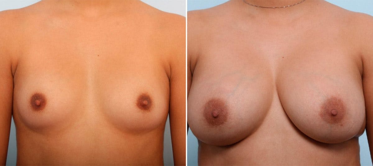 Breast Augmentation Before & After Gallery - Patient 54887006 - Image 1