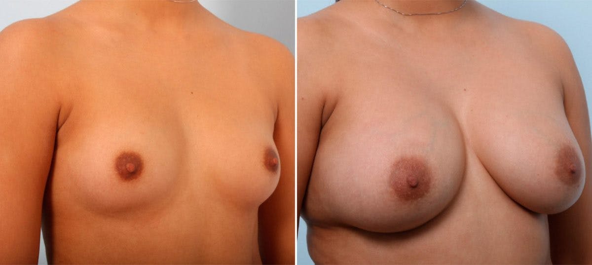 Breast Augmentation Before & After Gallery - Patient 54887006 - Image 2