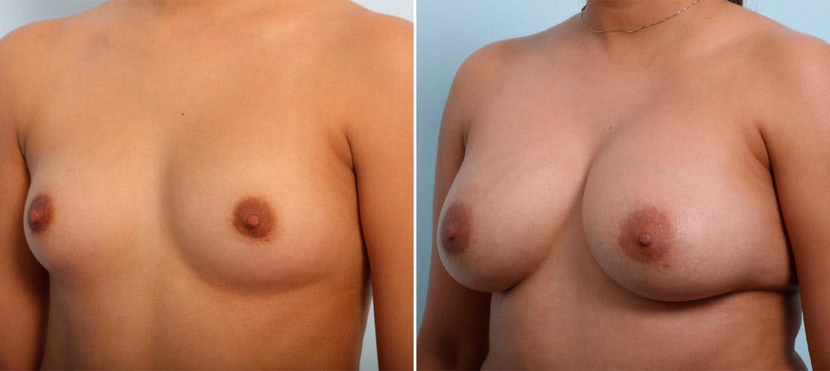 Breast Augmentation Before & After Gallery - Patient 54887006 - Image 4