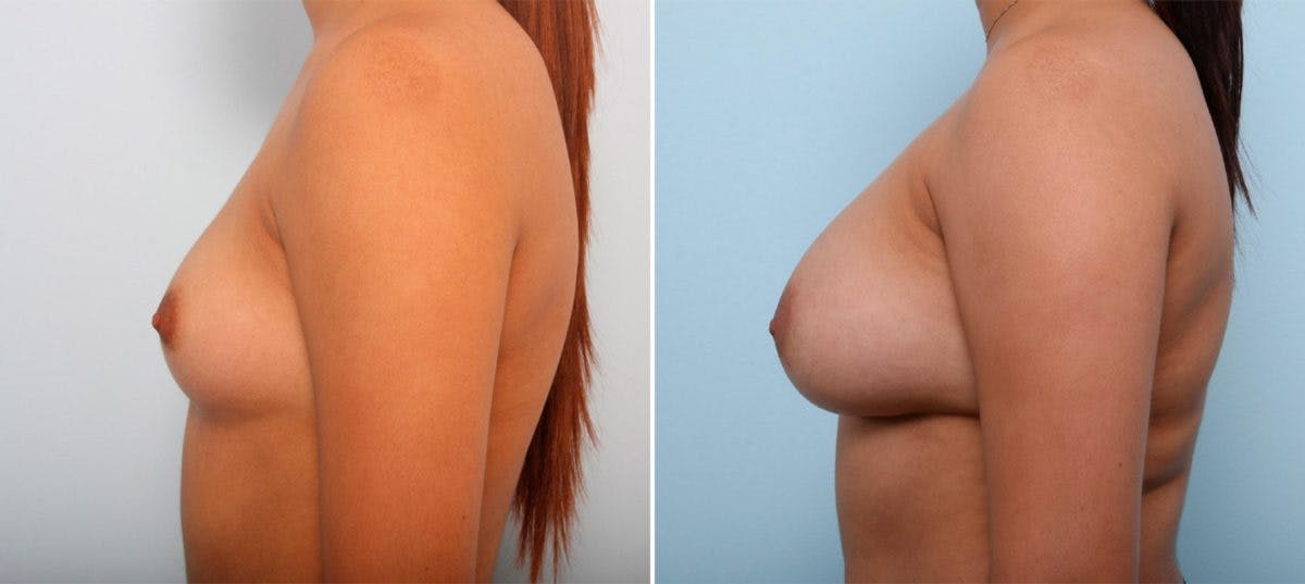 Breast Augmentation Before & After Gallery - Patient 54887006 - Image 5