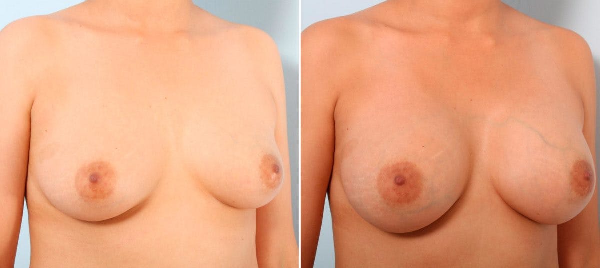 Breast Augmentation Before & After Gallery - Patient 54887008 - Image 2