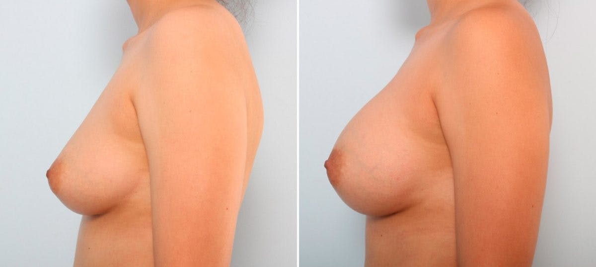 Breast Augmentation Before & After Gallery - Patient 54887008 - Image 5