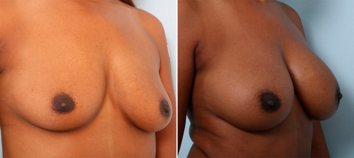 Breast Augmentation Before & After Gallery - Patient 54887010 - Image 2