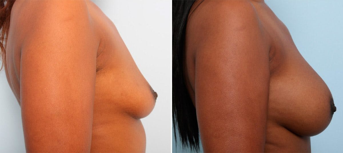 Breast Augmentation Before & After Gallery - Patient 54887010 - Image 3
