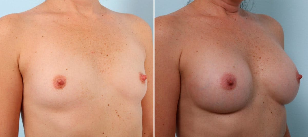 Breast Augmentation Before & After Gallery - Patient 54887011 - Image 2
