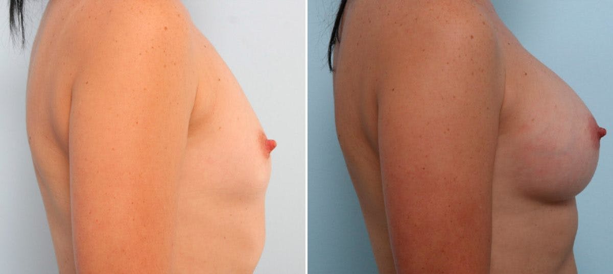 Breast Augmentation Before & After Gallery - Patient 54887011 - Image 3