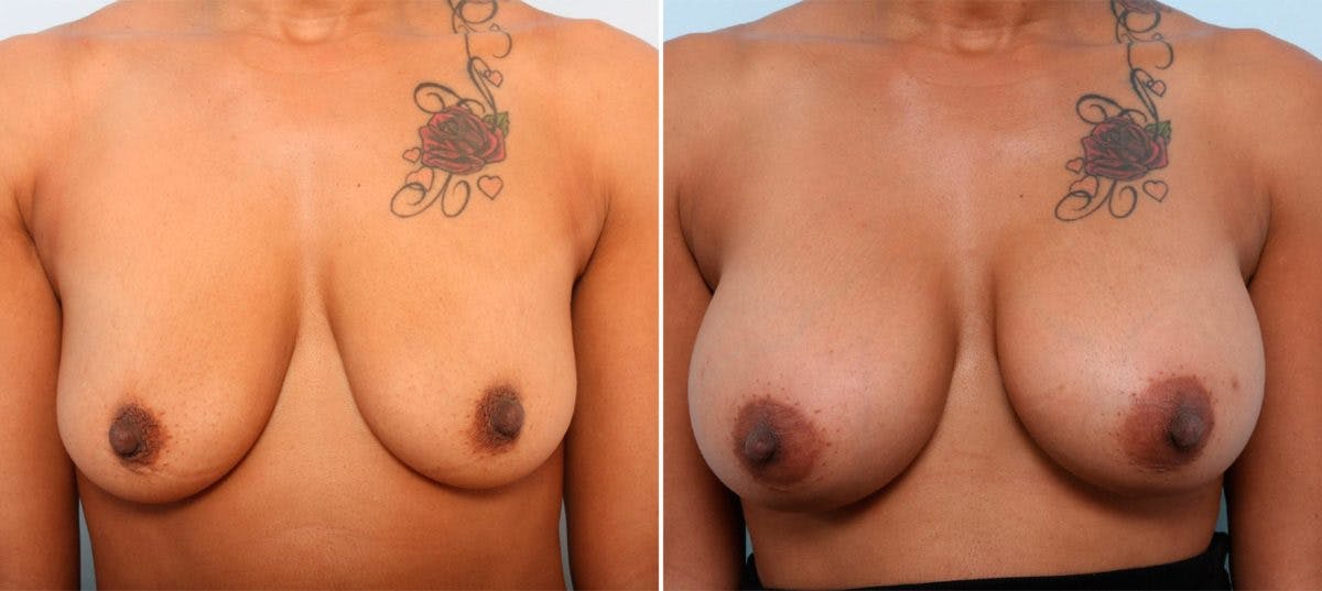 Breast Augmentation Before & After Gallery - Patient 54887012 - Image 1