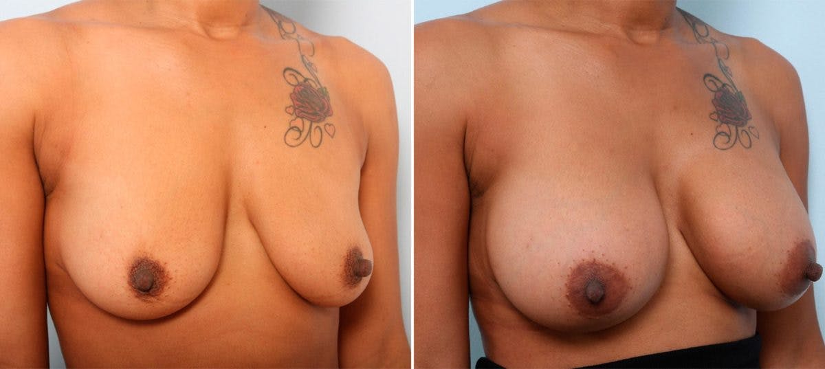 Breast Augmentation Before & After Gallery - Patient 54887012 - Image 2
