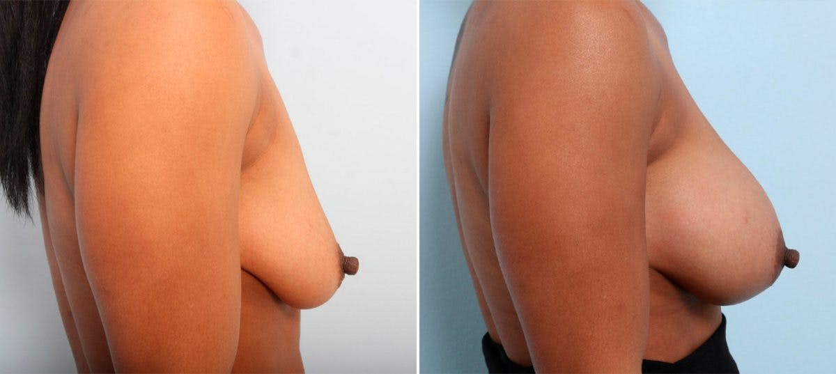 Breast Augmentation Before & After Gallery - Patient 54887012 - Image 3