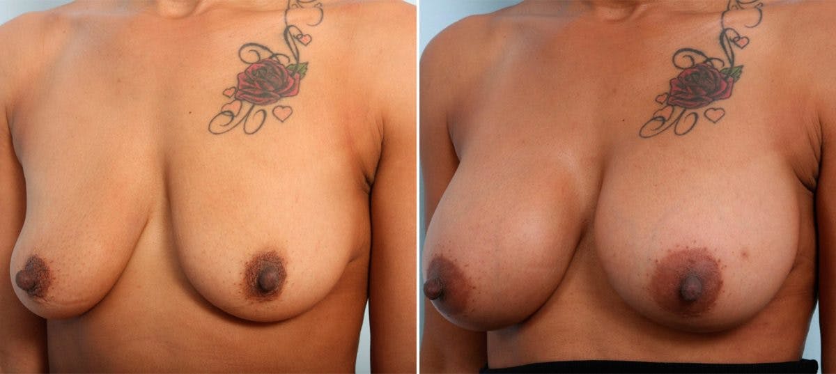 Breast Augmentation Before & After Photo - Patient 54887012 - Image 4