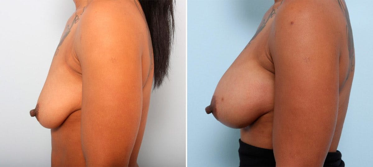 Breast Augmentation Before & After Photo - Patient 54887012 - Image 5
