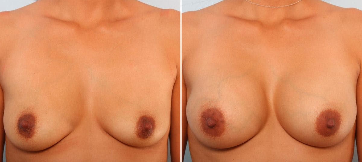 Breast Augmentation Before & After Gallery - Patient 54887014 - Image 1
