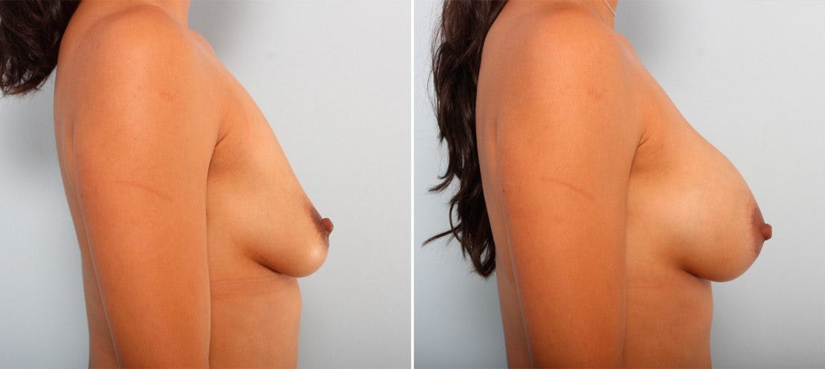 Breast Augmentation Before & After Gallery - Patient 54887014 - Image 3