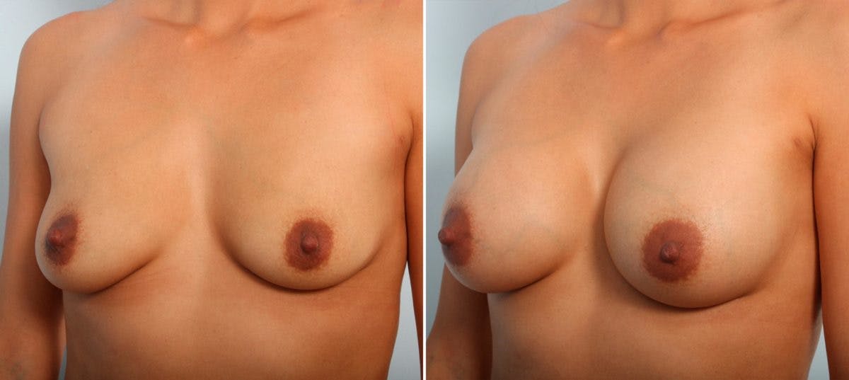 Breast Augmentation Before & After Gallery - Patient 54887014 - Image 4