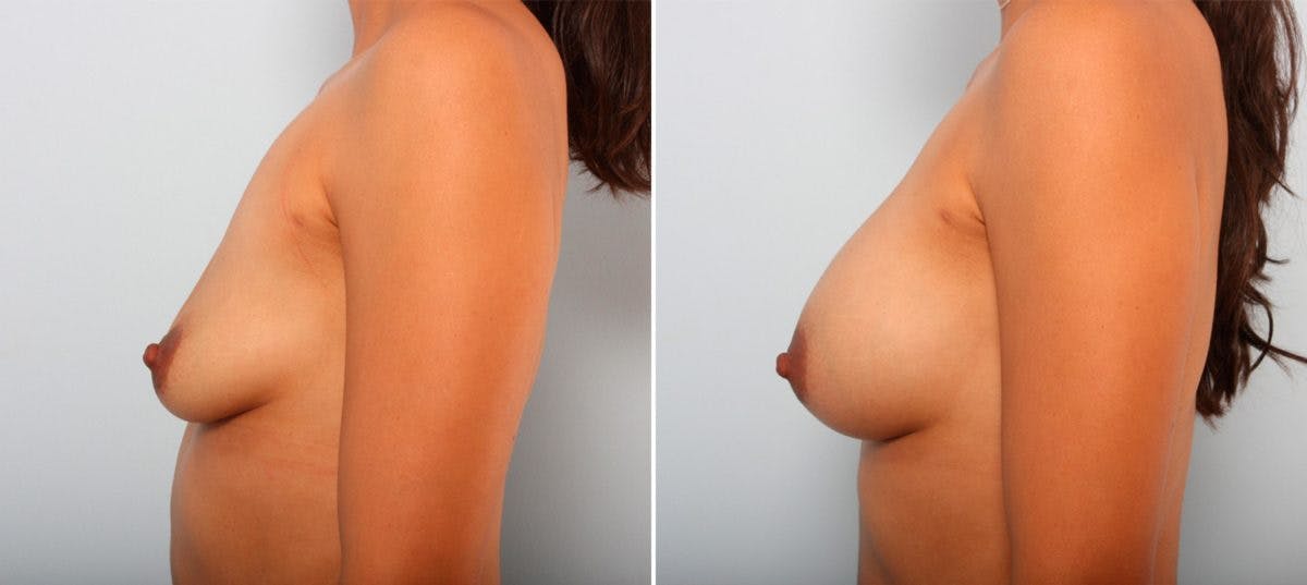 Breast Augmentation Before & After Gallery - Patient 54887014 - Image 5