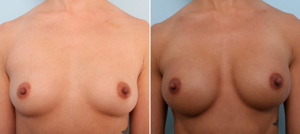 Breast Augmentation Before & After Gallery - Patient 54887015 - Image 1