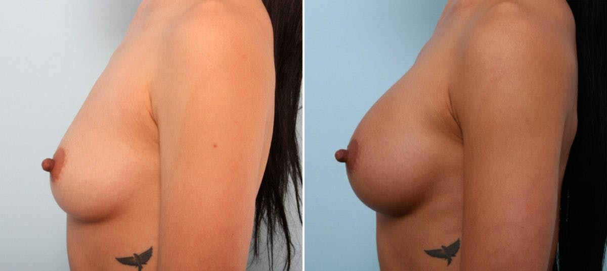 Breast Augmentation Before & After Gallery - Patient 54887015 - Image 5