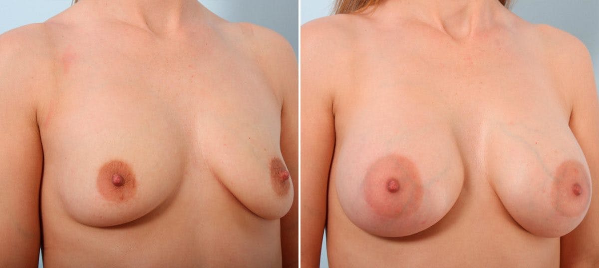 Breast Augmentation Before & After Gallery - Patient 54887018 - Image 2