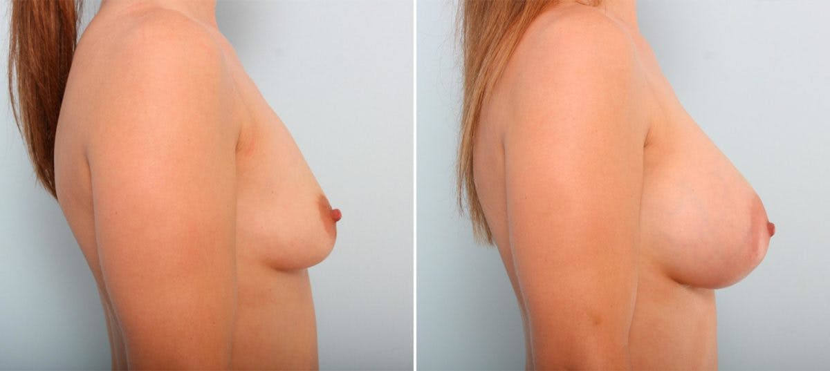 Breast Augmentation Before & After Gallery - Patient 54887018 - Image 3