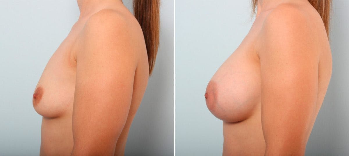 Breast Augmentation Before & After Gallery - Patient 54887018 - Image 5
