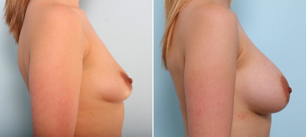 Breast Augmentation Before & After Gallery - Patient 54887021 - Image 3