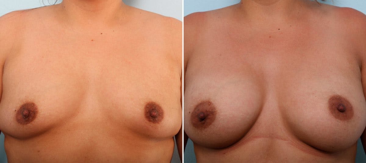 Breast Augmentation Before & After Gallery - Patient 54887029 - Image 1