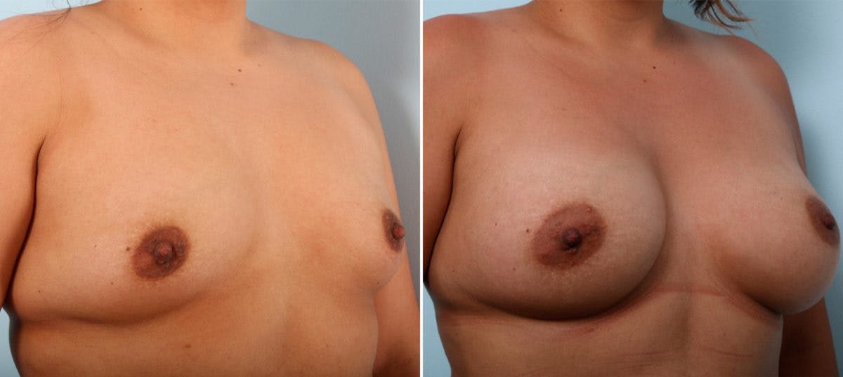 Breast Augmentation Before & After Gallery - Patient 54887029 - Image 2