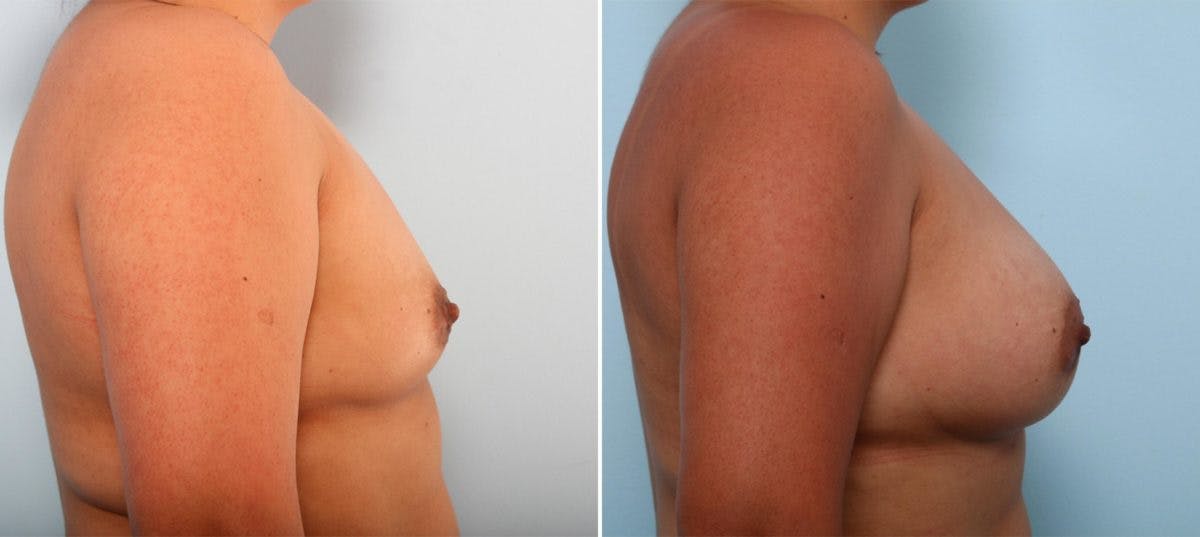 Breast Augmentation Before & After Gallery - Patient 54887029 - Image 3