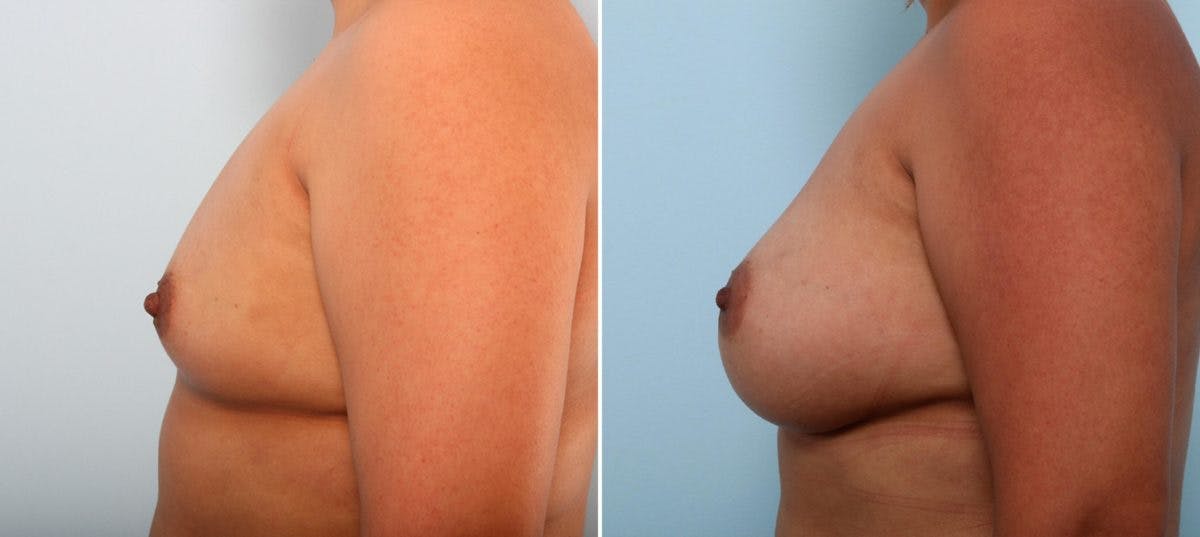 Breast Augmentation Before & After Gallery - Patient 54887029 - Image 5