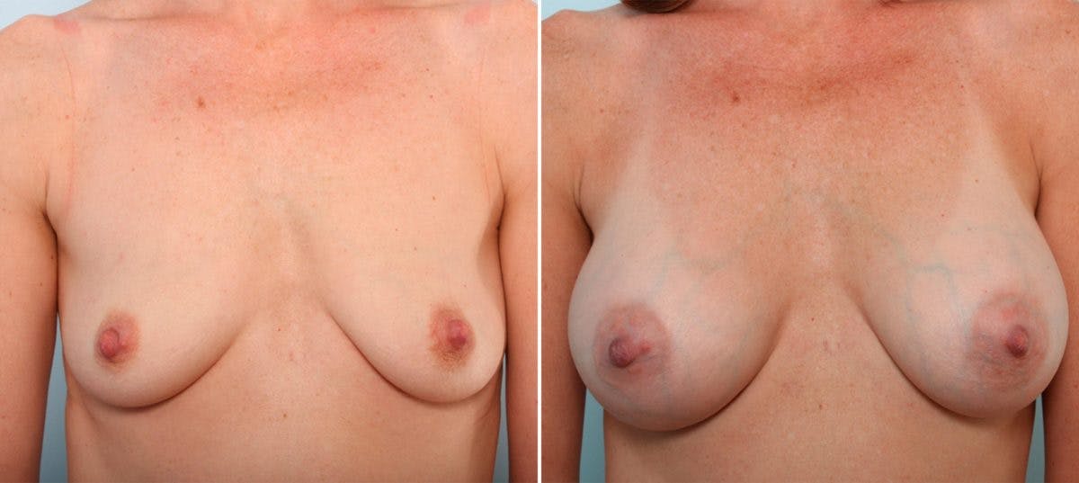 Breast Augmentation Before & After Gallery - Patient 54887052 - Image 1