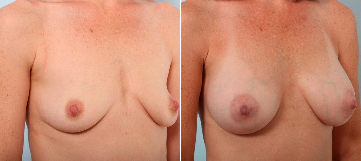 Breast Augmentation Before & After Gallery - Patient 54887052 - Image 2