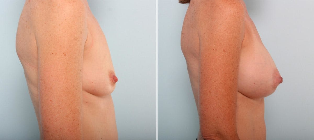 Breast Augmentation Before & After Gallery - Patient 54887052 - Image 3