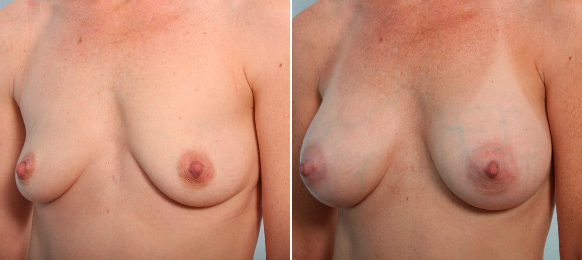 Breast Augmentation Before & After Gallery - Patient 54887052 - Image 4
