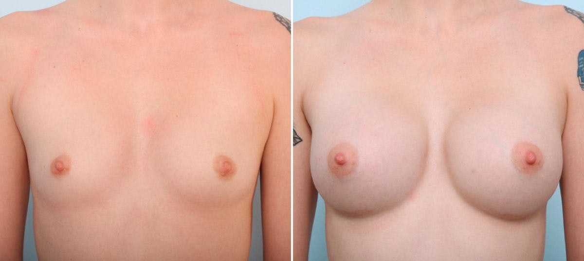 Breast Augmentation Before & After Gallery - Patient 54887094 - Image 1