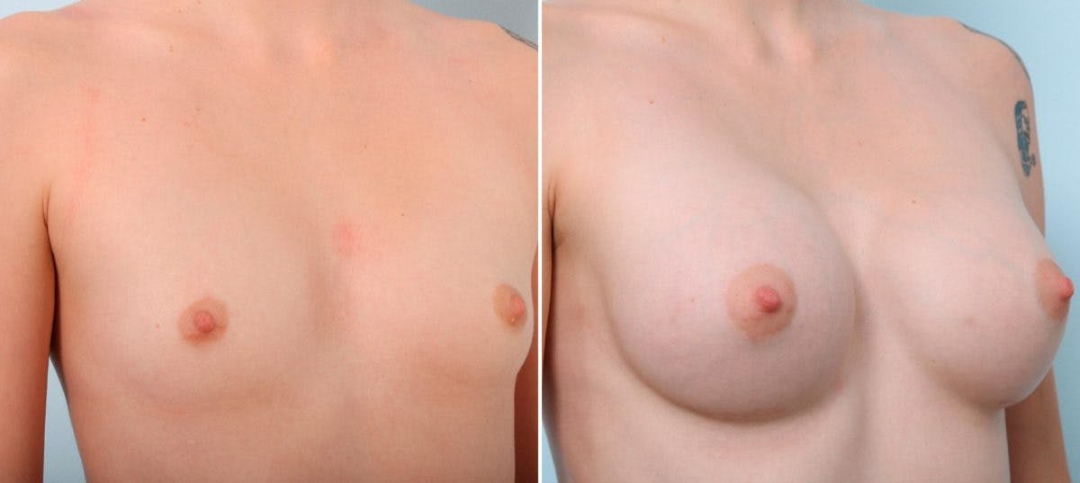 Breast Augmentation Before & After Gallery - Patient 54887094 - Image 2