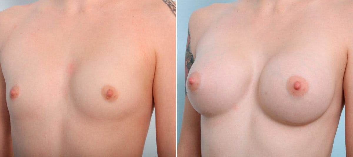 Breast Augmentation Before & After Gallery - Patient 54887094 - Image 4